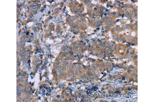 Immunohistochemistry of Human breast cancer using PON1 Polyclonal Antibody at dilution of 1:40 (PON1 抗体)