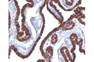 Formalin-fixed, paraffin-embedded human ovarian carcinoma stained with Cytokeratin 7 antibody (KRT7/760) (Cytokeratin 7 抗体)