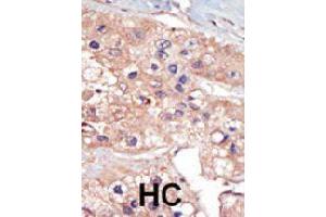 Formalin-fixed and paraffin-embedded human hepatocellular carcinoma tissue reacted with UHMK1 polyclonal antibody  , which was peroxidase-conjugated to the secondary antibody, followed by DAB staining.