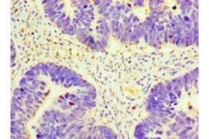 Immunohistochemistry of paraffin-embedded human ovarian cancer using ABIN7164669 at dilution of 1:100