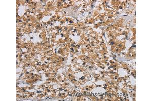 Immunohistochemistry of Human liver cancer using INPPL1 Polyclonal Antibody at dilution of 1:40 (INPPL1 抗体)