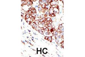 Formalin-fixed and paraffin-embedded human hepatocellular carcinoma tissue reacted with PIAS1 polyclonal antibody , which was peroxidase-conjugated to the secondary antibody, followed by DAB staining. (PIAS1 抗体  (C-Term))