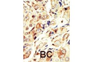 Formalin-fixed and paraffin-embedded human cancer tissue reacted with IGF1R polyclonal antibody  , which was peroxidase-conjugated to the secondary antibody, followed by DAB staining. (IGF1R 抗体  (N-Term))