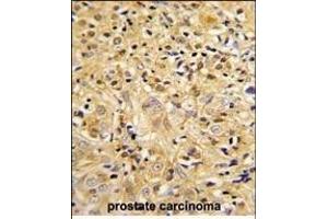 Formalin-fixed and paraffin-embedded human prostate carcinoma reacted with LUM Antibody (Center), which was peroxidase-conjugated to the secondary antibody, followed by DAB staining. (LUM 抗体  (AA 198-227))