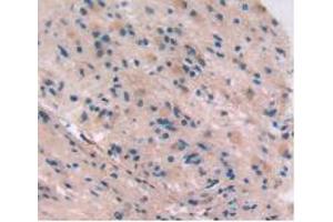 IHC-P analysis of Human Glioma Tissue, with DAB staining. (Integrin beta 5 抗体  (AA 137-378))