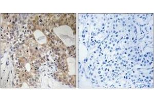 Immunohistochemistry analysis of paraffin-embedded human breast carcinoma, using SPHK2 (Phospho-Thr614) Antibody. (SPHK2 抗体  (pThr614))