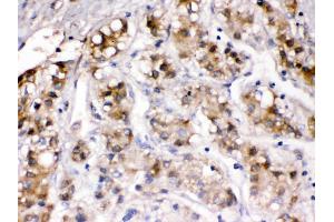 Ceruloplasmin was detected in paraffin-embedded sections of human liver cancer tissues using rabbit anti- Ceruloplasmin Antigen Affinity purified polyclonal antibody at 1 μg/mL. (Ceruloplasmin 抗体  (AA 20-259))
