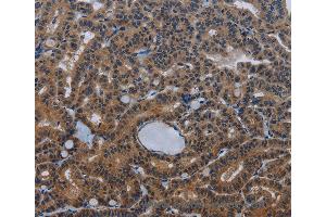 Immunohistochemistry of Human thyroid cancer using INSIG2 Polyclonal Antibody at dilution of 1:30