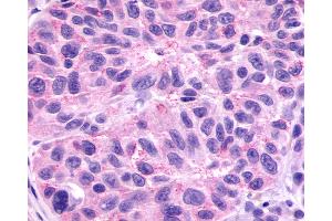 Anti-GPR78 antibody IHC of human Skin, Melanoma. (GPR78 抗体  (Cytoplasmic Domain))