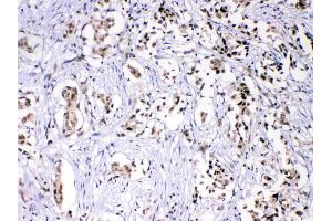 HnRNPF was detected in paraffin-embedded sections of human mammary cancer tissues using rabbit anti- HnRNPF Antigen Affinity purified polyclonal antibody (Catalog # ) at 1 µg/mL. (HNRNPF 抗体  (N-Term))