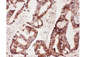 IHC-P: CNTF antibody testing of human lung cancer tissue (CNTF 抗体  (AA 2-200))