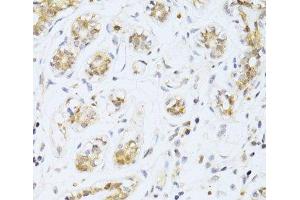 Immunohistochemistry of paraffin-embedded Human breast cancer using ETV1 Polyclonal Antibody at dilution of 1:100 (40x lens).