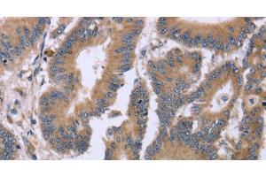Immunohistochemistry of paraffin-embedded Human colon cancer tissue using KIAA1324 Polyclonal Antibody at dilution 1:30 (ELAPOR1 抗体)