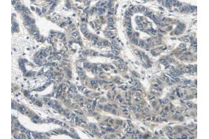 IHC-P analysis of Human Lung Cancer Tissue, with DAB staining. (ERBB4 抗体  (AA 29-278))