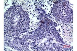 Immunohistochemistry (IHC) analysis of paraffin-embedded Human Lung Cancer, antibody was diluted at 1:100. (PDGFD 抗体  (C-Term))