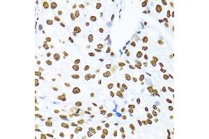 Immunohistochemistry of paraffin-embedded human prostate cancer using KHDRBS1 antibody. (KHDRBS1 抗体  (C-Term))