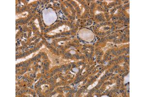 Immunohistochemistry of Human lymphoma using CCL23 Polyclonal Antibody at dilution of 1:50 (CCL23 抗体)