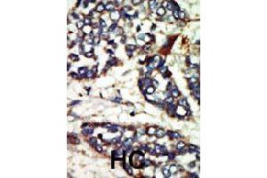 Formalin-fixed and paraffin-embedded human hepatocellular carcinoma tissue reacted with NEK1 polyclonal antibody  , which was peroxidase-conjugated to the secondary antibody, followed by DAB staining. (NEK1 抗体  (C-Term))