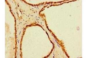 Immunohistochemistry of paraffin-embedded human prostate cancer using ABIN7151711 at dilution of 1:100 (LACTB2 抗体  (AA 6-288))