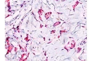 Formalin-fixed, paraffin-embedded breast lobular carcinoma stained with Catenin, beta PAb.