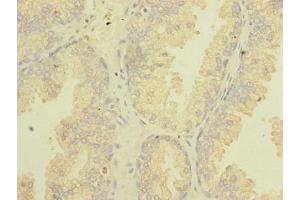 Immunohistochemistry of paraffin-embedded human prostate cancer using ABIN7171826 at dilution of 1:100 (Twisted Gastrulation BMP Signaling Modulator 1a (TWSG1A) (AA 1-200) 抗体)