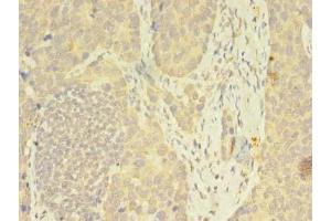 Immunohistochemistry of paraffin-embedded human gastric cancer using ABIN7162815 at dilution of 1:100 (FKBP11 抗体  (AA 28-154))