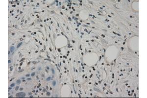 Immunohistochemical staining of paraffin-embedded Carcinoma of pancreas tissue using anti-SLC2A5mouse monoclonal antibody. (SLC2A5 抗体)