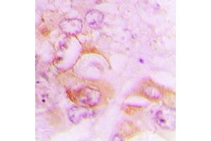 Immunohistochemical analysis of Septin 7 staining in human lung cancer formalin fixed paraffin embedded tissue section. (Septin 7 抗体  (C-Term))