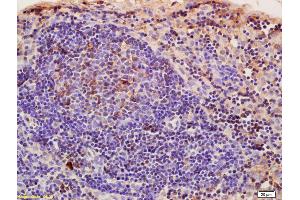 Formalin-fixed and paraffin embedded rat pancreatic cancer labeled with Anti-CRIM1 Polyclonal Antibody, Unconjugated (ABIN676853) at 1:200, followed by conjugation to the secondary antibody and DAB staining (CRIM1 抗体  (AA 901-1028))