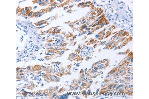 Immunohistochemistry of Human lung cancer using KIF3A Polyclonal Antibody at dilution of 1:40 (KIF3A 抗体)