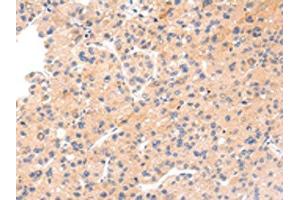The image on the left is immunohistochemistry of paraffin-embedded Human liver cancer tissue using ABIN7191067(IKZF4 Antibody) at dilution 1/20, on the right is treated with synthetic peptide. (IKZF4 抗体)