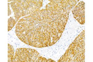 Immunohistochemistry (IHC) image for anti-Epithelial Cell Adhesion Molecule (EPCAM) (AA 24-265) antibody (ABIN7453970) (Recombinant EpCAM 抗体  (AA 24-265))