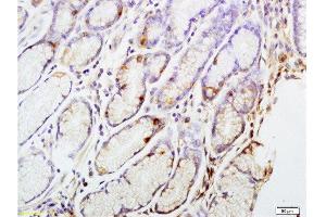 Formalin-fixed and paraffin embedded human gastric carcinoma tissue labeled with Anti-CENPA Polyclonal Antibody, Unconjugated at 1:200 followed by conjugation to the secondary antibody and DAB staining (CENPA 抗体  (AA 65-140))