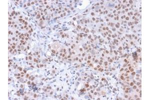 Formalin-fixed, paraffin-embedded human Colon Carcinoma stained with RNA Polymerase II / Poll II Mouse Monoclonal Antibody (8A7). (POLR2A/RPB1 抗体  (pSer5))