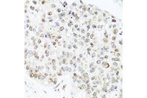 Immunohistochemistry of paraffin-embedded human lung cancer using CETN3 antibody (ABIN5974786) at dilution of 1/100 (40x lens). (CETN3 抗体)
