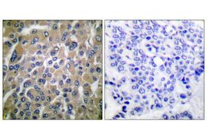 Immunohistochemical analysis of paraffin-embedded human breast carcinoma tissue using hCG beta antibody (ABIN5976419). (HCG beta 抗体  (C-Term))