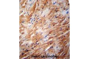 TFB2M Antibody (C-term) immunohistochemistry analysis in formalin fixed and paraffin embedded human heart carcinoma followed by peroxidase conjugation of the secondary antibody and DAB staining. (TFB2M 抗体  (C-Term))