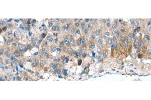 Immunohistochemistry of paraffin-embedded Human liver cancer tissue using HSD11B1 Polyclonal Antibody at dilution of 1:70(x200) (HSD11B1 抗体)