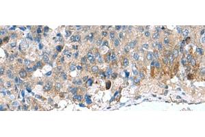 Immunohistochemistry of paraffin-embedded Human liver cancer tissue using HSD11B1 Polyclonal Antibody at dilution of 1:70(x200) (HSD11B1 抗体)