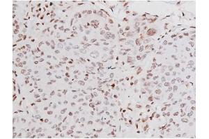 ABIN6267365 at 1/200 staining Human lung cancer tissue sections by IHC-P. (KIT 抗体  (pTyr721))