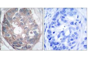 Immunohistochemical analysis of paraffin-embedded human breast carcinoma tissue, using Dab1 (Ab-232) antibody (E021251). (DAB1 抗体)