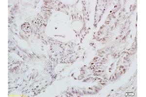 Formalin-fixed and paraffin embedded human colon carcinoma tissue labeled with Anti-LEF-1 Polyclonal Antibody, Unconjugated at 1:200 followed by conjugation to the secondary antibody and DAB staining (LEF1 抗体  (AA 331-399))