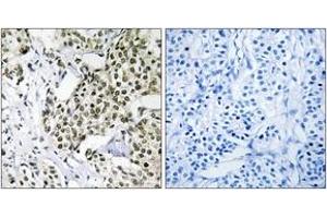 Immunohistochemistry analysis of paraffin-embedded human breast carcinoma tissue, using CAGE1 Antibody. (CAGE1 抗体  (AA 711-760))
