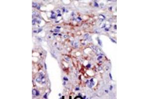 Formalin-fixed and paraffin-embedded human cancer tissue reacted with the primary antibody, which was peroxidase-conjugated to the secondary antibody, followed by AEC staining. (PIP5K1C 抗体  (N-Term))
