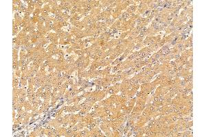 ABIN7094620 and ABIN7098670 at 1/100 staining Human liver cancer and adjacent normal tissues by IHC-P. (CRAT 抗体  (Internal Region))
