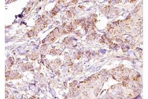 ABIN6274832 at 1/100 staining Human breast cancer tissue by IHC-P. (ACER3 抗体  (Internal Region))