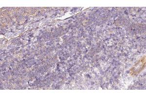 ABIN6273057 at 1/100 staining Human lymph cancer tissue by IHC-P. (MTHFD2 抗体  (N-Term))