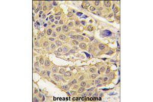 Formalin-fixed and paraffin-embedded human breast carcinoma tissue reacted with EPRS polyclonal antibody  , which was peroxidase-conjugated to the secondary antibody, followed by DAB staining. (EPRS 抗体  (N-Term))