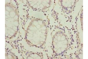 Immunohistochemistry of paraffin-embedded human colon cancer using ABIN7165635 at dilution of 1:100 (HOOK1 抗体  (AA 301-600))