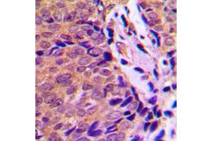 Immunohistochemical analysis of Ah Receptor (pS36) staining in human breast cancer formalin fixed paraffin embedded tissue section.